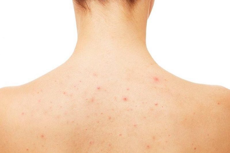 cach-tri-mun-lung-tai-nha-1.jpg