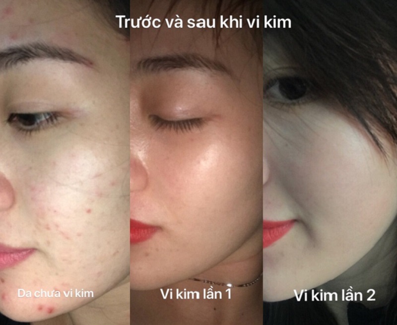 skincare-cho-da-dau-mun-7.jpg