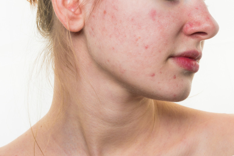 skincare-sau-khi-nan-mun-8.jpg